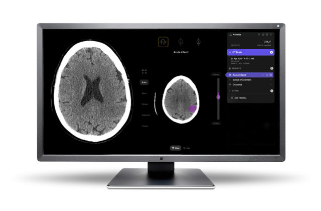 Unilabs s pomocou riešenia Annalise.ai poskytne pacientom inovatívne možnosti diagnostiky závažných prípadov CNS