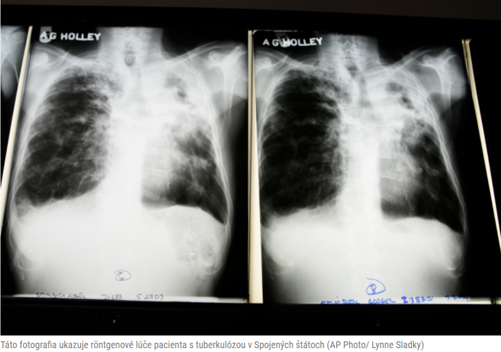 Vážny problém Ukrajiny s tuberkulózou by mohol predstavovať problémy v oblasti verejného zdravia počas utečeneckej krízy v Česku