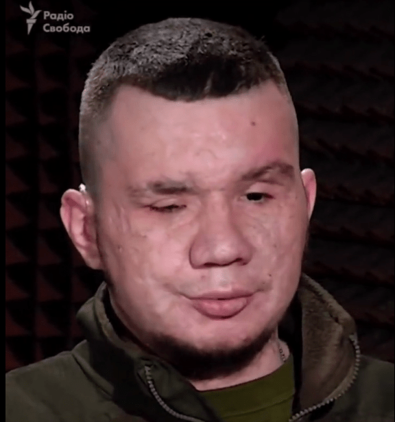 Ukrajinský bojovník Vladyslav Ješčenko prišiel o obe oči, keď mu pri odmínovaní vybuchlo 84 mín