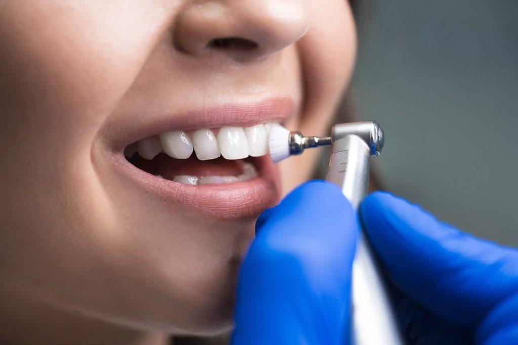 Váhate, či absolvovať dentálnu hygienu? Prezradíme vám dôvody, ktoré vás presvedčia